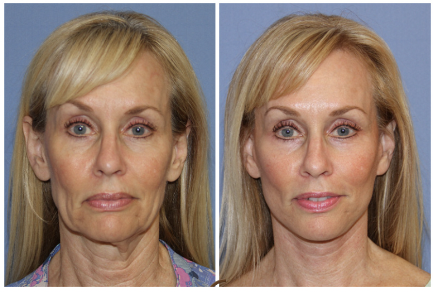 Exion™ RF Microneedling before and after — Jawline and Neck
